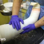 AI Pilot Program Launches at Northern Lincolnshire Trust to Improve Fracture Diagnosis