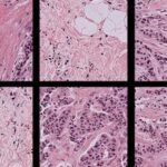 AI Pathology Models Show 29% Bias in Cancer Detection Across Demographics, Study Reveals