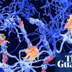 AI Reveals Two New Subtypes of Multiple Sclerosis, Transforming Treatment Approaches