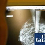 AI-Enhanced Mammography Reduces Breast Cancer Diagnoses by 12% in Landmark Study