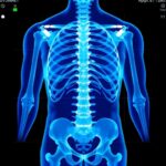 Machine Learning Tool Enhances Osteoporosis Screening Accuracy Using SHAP Method