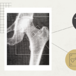 Machine Learning Advances Bone Imaging, Enhances Diagnosis and Treatment Monitoring