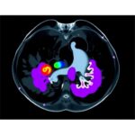 Researchers Unveil BUSGen, a Foundation AI Model that Improves Breast Ultrasound Diagnosis by 16.5%